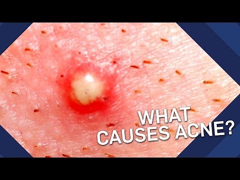 What Causes Acne? | Earth Science