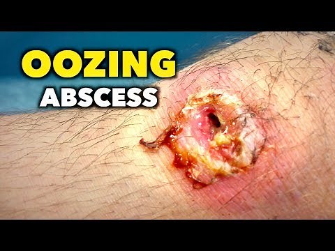 OOZING ABSCESS on KNEECAP! | Dr. Paul