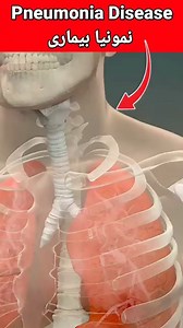9.6K views · 556 reactions | Pneumonia Disease Causes, Sign Symptoms,...