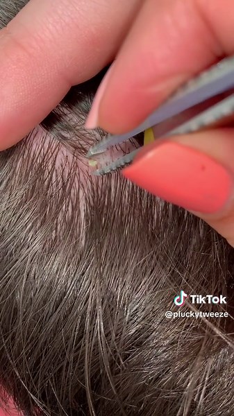 Satisfying Ingrown Hair Removal Compilation