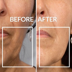 Want to give your skin an instant lift? Our NEW Anew Lift & Tighten Serum helps to firm and lift your skin, leaving facial contours looking refined. Just take a look at this before & after transformation! Order now: https://bit.ly/3EF8gPJ #NewProduct #AnewPlatinumSerum #EmbraceYourPower #AvonSouthAfrica | Avon