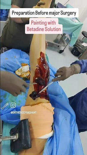Surgical Preparation for Knee Replacement Surgery #Steriletechnique #Hospital #KneeSurgery
