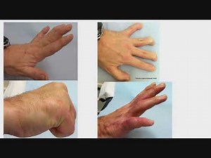 Hand Anatomy and Biomechanics