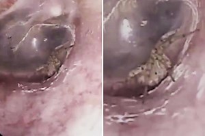 Spider removed from woman's ear
