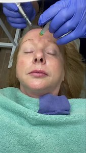 李Derma Pen using Platelet Rich Plasma - gives excellent results 李 It’s the  to rejuvenation Telephone 01293 404040 Or Email thebackcareclinic@gmail.com | The Back Care Clinic | Facebook