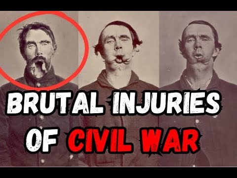 Civil War AMPUTATIONS: The War with the WORST Wounds