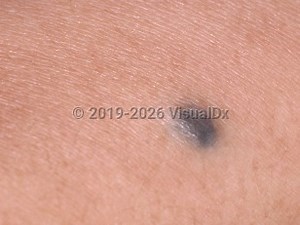 VisualDx - Blue nevus