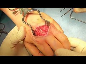 SAGITTAL BAND RECONSTRUCTION FOR CHRONIC EXTENSOR TENDON DISLOCATION