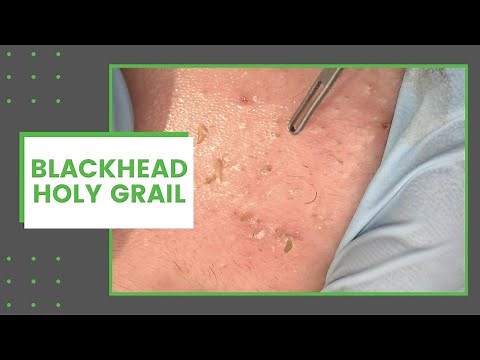 Blackhead Holy Grail | Dr. Derm