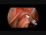Maladie de Hirschsprung - Intervention Curatrice de Swenson Par Voie Laparoscopique • Vidéo • Site médical MEDtube.fr