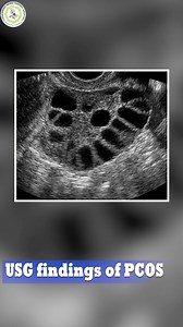 Sympotms of PCOS full podcast watch in you tube subharti hospital video #subhartihospital #subhartihospitalmeerut #pcos #subharti #gynecology #gynaecologist | Subharti Hospital
