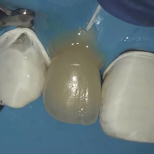 By @dr.rafapineiro ・・・ Pre polimerization to remove cement excess, 😃 note the adjustment !! I can’t see the finishing line under 10x magnification #veneers #dentista #dentalesthetics #esteticadental #emax #allaboutesthetics2020 | identistry