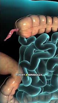 Appendectomy Surgery Explained 🇱🇷 How Doctors Remove Your Appendix 🩺