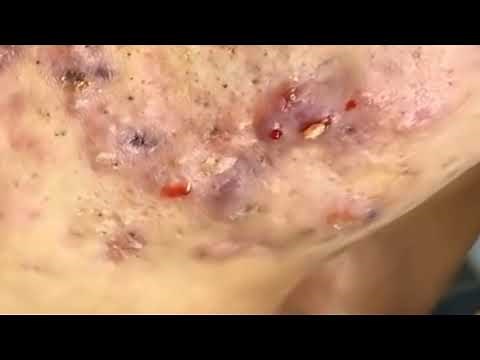 Pimple Popping / Pimple popping 2021/ Blackhead Removal / Satisfying Video New September 2021