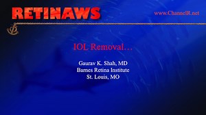 IOL Removal - Eyetube