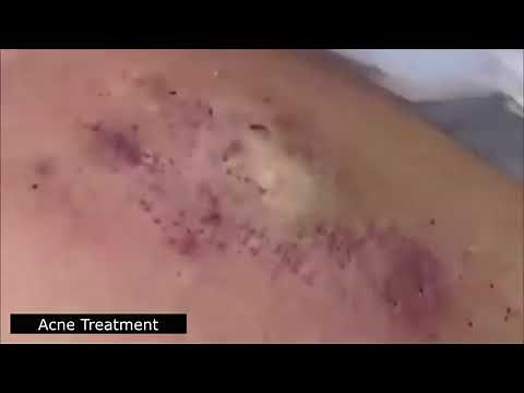 BEST BLACKHEAD AND WHITEHEAD REMOVAL! SEVERE ACNE TREATMENT - SATISFYING AND RELAXING VIDEO