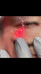 UltraPulse Alpha targets deep wrinkles, severe textural issues from sun damage, blotchiness, acne scars and surgical scars! P.S.! It also stimulates the production of collagen @lumenis #lumenis #ULTRApulseAlpha #sundamagedskin | Lumenis Aesthetic