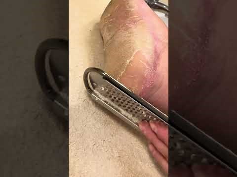 EXTREME CALLUS Clipping & Rasping ASMR Pedicure - Hyperkeratosis EPPK Foot Callus - Oct 30, 2023