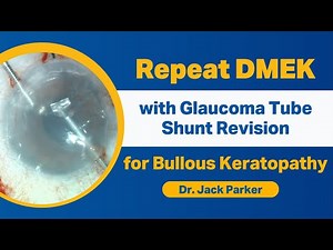 Repeat DMEK with Glaucoma Tube Shunt Revision for Bullous Keratopathy