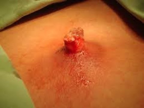 INCISION AND DRAINAGE ABSCESS | CYST 2020
