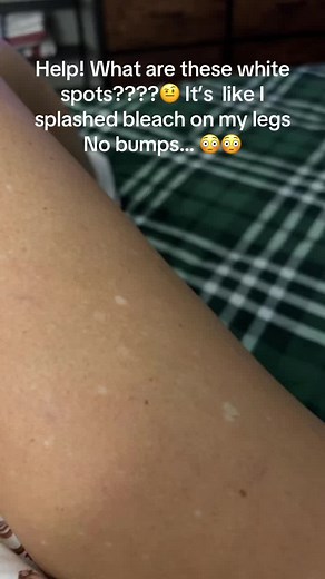 Understanding White Spots on Legs: Causes and Solutions