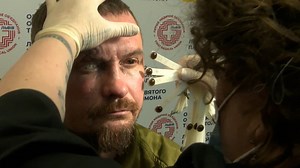 War victims in Ukraine receive advanced eye prosthetics