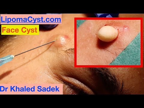 Massive Face Cyst. Dr Khaled Sadek. LipomaCyst.com