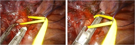 A Pulley-Assisted Ligature Technique for Safe and Versatile Vascular Division During Uniportal Video-Assisted Thoracic Surgery