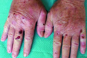 What is porphyria? Diagnosis and treatment of this genetic disease