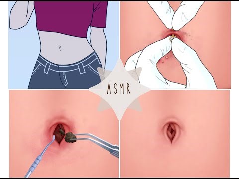 [ASMR] Dirt and Stone Removal in Deep Belly Button | Remove Navel Stone Animation