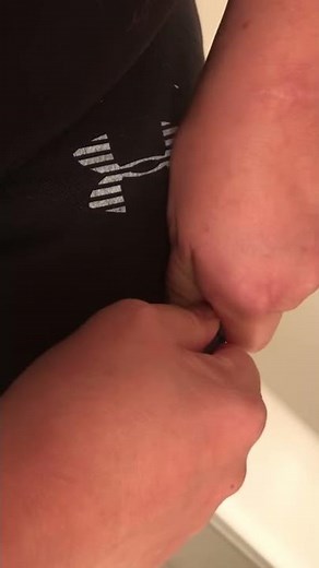 Nephrostomy Life 💗Changing bags