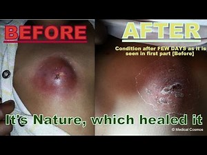 CHEST ABSCESS FOLLOW UP