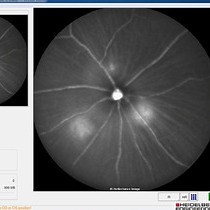 Video: In Vivo Multimodal Imaging and Analysis of Mouse Laser-Induced Choroidal Neovascularization Model
