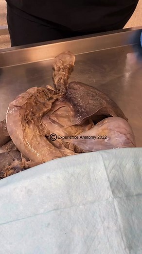 Understanding Pleurae Anatomy: Layers, Fluid, and Function