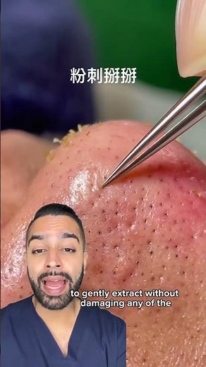Sebaceous Filaments Extraction on Nose | - Dr Somji Reacts