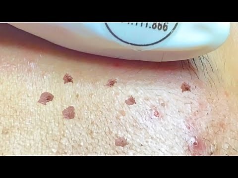 Deep Acne Extraction with Long Pus Cores | Relaxing Facial for Severe Acne Skin #8