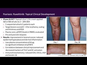 JAK-Inhibition in Immune-Mediated Diseases (IMiDs)