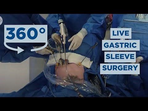 Watch a Gastric Sleeve Surgery in Live 360​​​​°​​ | Obesity Control Center