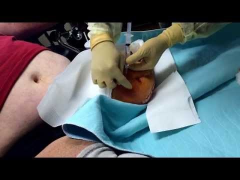 Abscess in left stump drainage