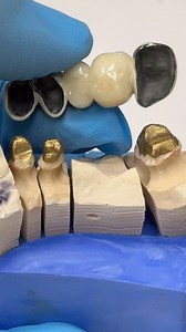 Hygiene pontic with Porcelain butt joints! | CEO Luke Kahng