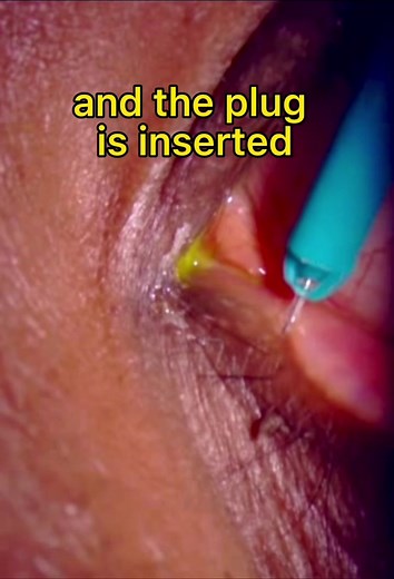Punctal plug insertion technique - great for dry eyes once maximal medical treatment is reached. #dryeyes #punctalplugs #technique #eyes #tech #oclvision