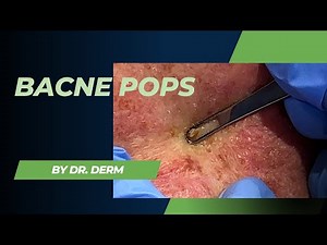 Bacne Pops | Dr. Derm