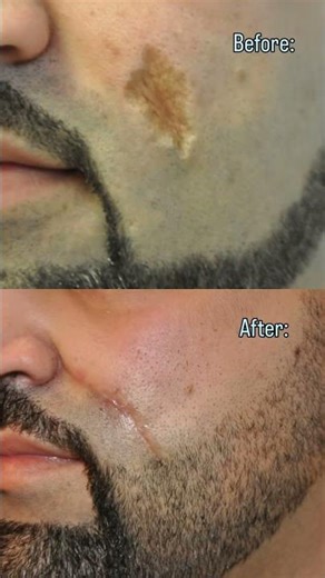 SCAR REVISION - DR. TANVEER JANJUA