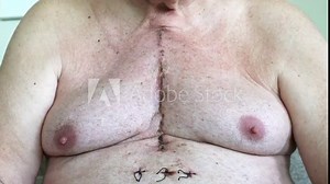 Scar from open heart surgery, where the sternum was cut in two, and the rib cage sprung. Below the scar holes show where the drains and pacemaker cables emerged. Image taken 12 days following surgery