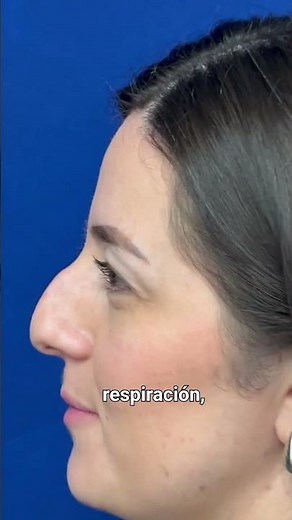 Paciente de rinoplastia antes y minutos después de cirugía! #cirugiadenariz #rinoplastia