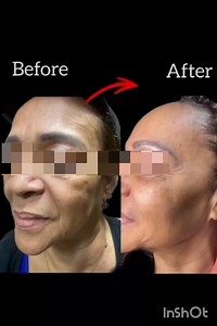 Pour corriger le relâchement cutané quand il est du à des fontes de coussinets de graisse et/ou à une résorption osseuse(vieillissement naturel) rien de tel qu'un filler comme l'acide hyaluronique #DrCarréDermoEsthétique#Fillers #juvedermfillers | Clinique Dermo- Esthétique Dr Jn Jacques Carre 60 rue Waag PaP | Facebook