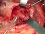 Gastroenteral anastomosis done by circular stapler • Video • MEDtube.net