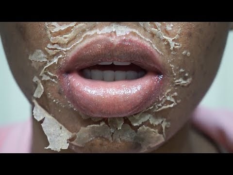 CHEMICAL PEEL Full Process | Procedure | Peeling | Before & After