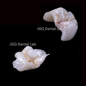 [Hot Item] All Ceramic IPS Emax Onlay Inlay China Dental Lab Affordable Price Zirconia Crowns