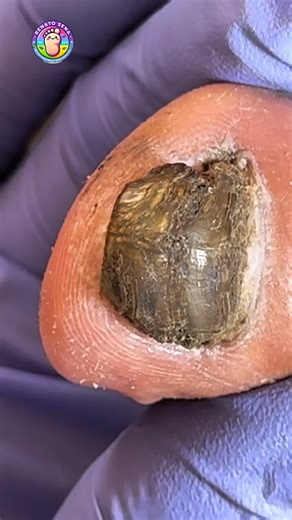 Natural Solutions for Toe Pressure #HolisticToeCare #NaturalRelief #WellnessJourneyUSA | Renato Sena